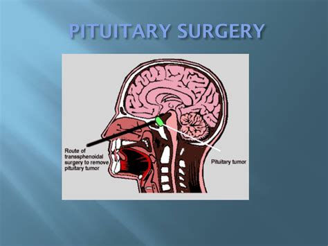 PPT - Pituitary Disorders PowerPoint Presentation, free download - ID ...