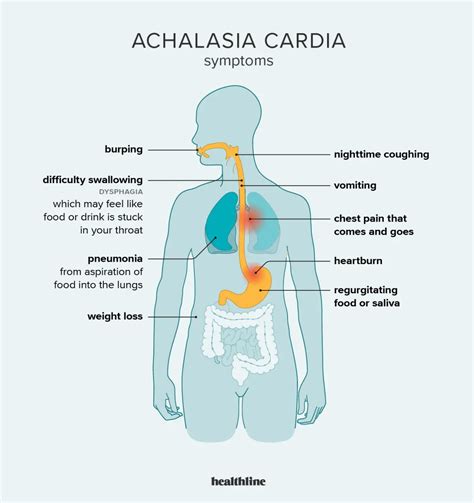 Esophageal Achalasia - Causes, Symptoms, Treatment - Healthy Food Near Me