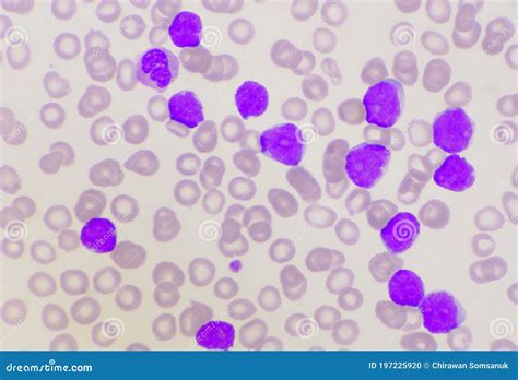 Group of Blast Cells in Leukemia Background Stock Photo - Image of ...