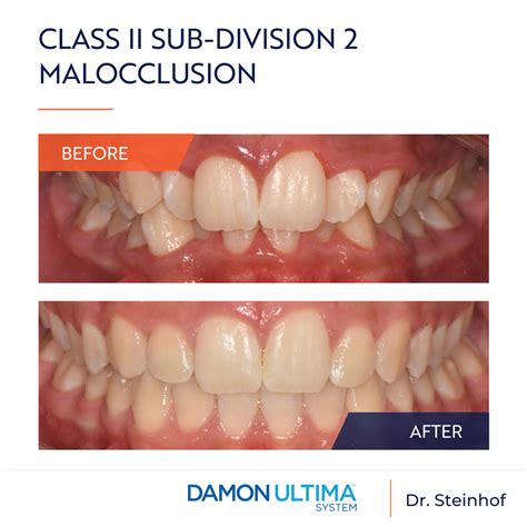 Class II sub-division 2 malocclusion with significant maxillary and ...