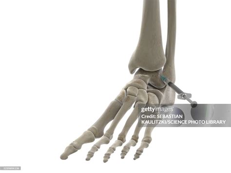 Image result for Ankle Injection Procedure