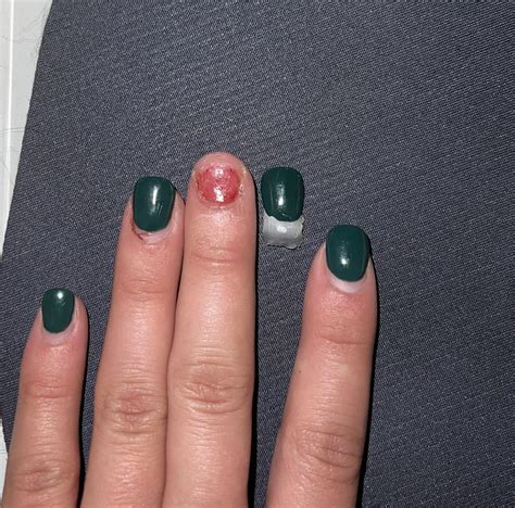 Why Is There A Lump Under My Nail Bed at Li Bell blog