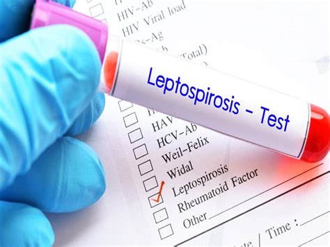 Suspected case of plague called leptospirosis in Rajkot | રાજકોટમાં ...