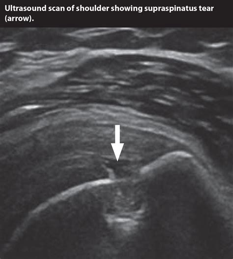 Musculoskeletal Ultrasound – Caring Medical