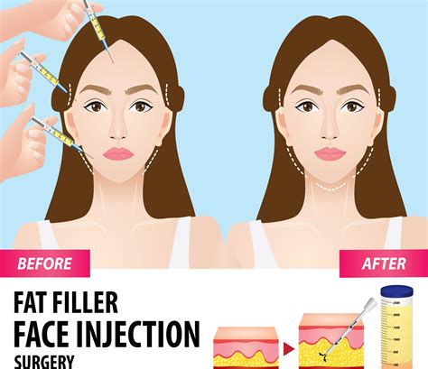 Facial Fillers Vs Fat Transfer at Josh Hayes blog