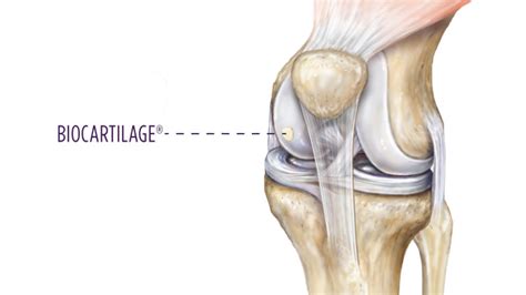 Dr. Skendzel Explains Treatments For Knee Cartilage Injuries | Summit Orthopedics