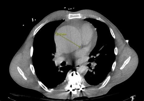 Aortic Root Dilation and Testosterone Use: Are They Associated? - Journal of Cardiothoracic and ...