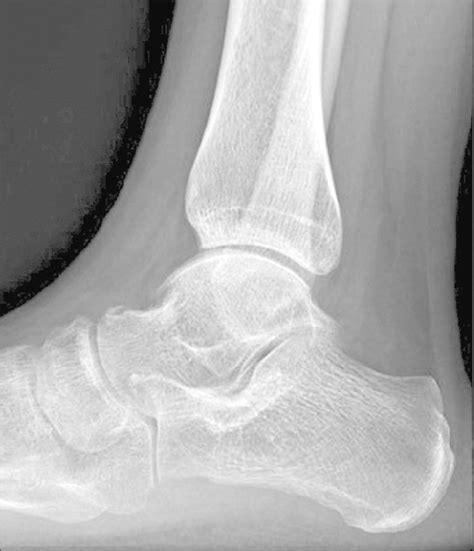 Lateral view of the ankle, which shows a talar neck fracture with a ...
