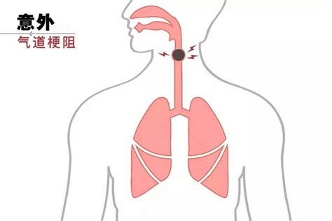 急救—异物卡喉怎么办？ _ 药最网 - www.yaozui.com