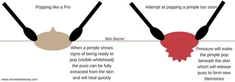 Do Pimples Bleed When You Pop Them at Louise Marion blog