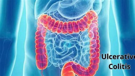 Ulcerative Colitis Surgery 的图像结果