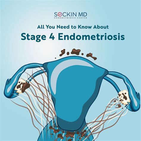 All You Need to Know About Stage 4 Endometriosis - Dr. Seckin