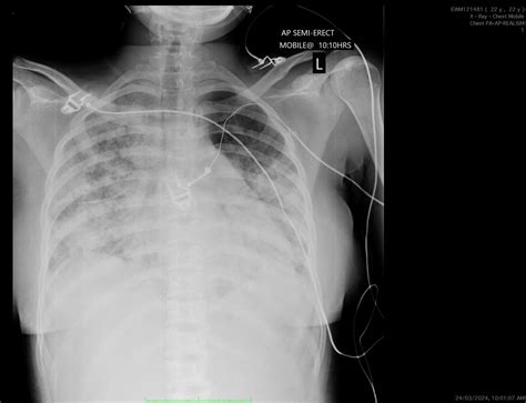 Acute painful crisis in adults with sickle cell disease | The BMJ