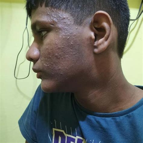 Gradual Facial Hyperpigmentation due to Sodium Valproate