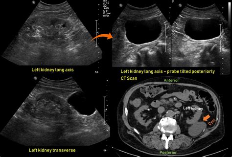 Kuvatulokset haulle parapelvic cyst kidney