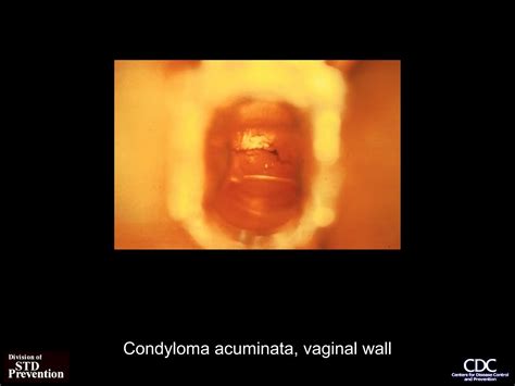 Condyloma_acuminata or study on candiasis.ppt