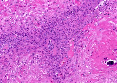 Pilar Cyst Histology Ulcerated Nodule On The Scalp | MDedge