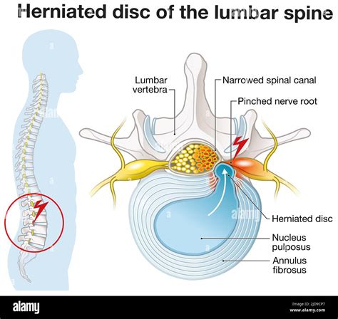 Illustration showing lumbar vertebra with intervertebral disc and ...