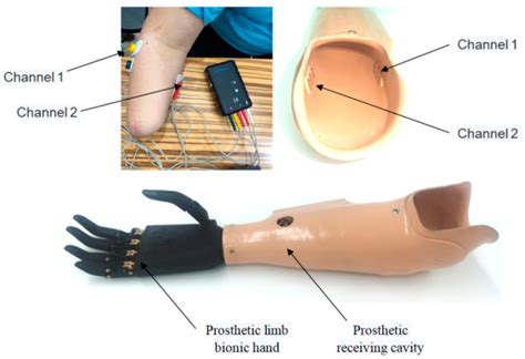 I Limb Bionic Hand