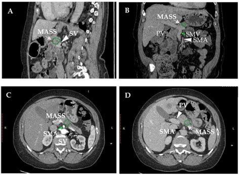 How A Patient with Resectable or Borderline Resectable Pancreatic ...