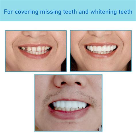 Denture Teeth Veneers for Whitening Teaching, Customizable Temporary ...