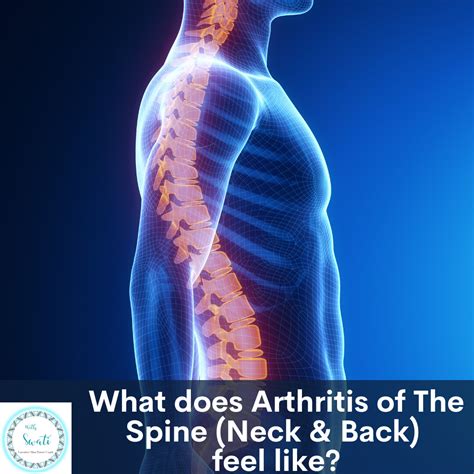 Causes Arthritis Of The Spine at Eve Milson blog