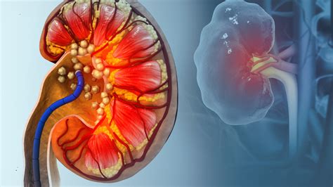 Kidney stones surge in summer: What’s driving the seasonal spike?