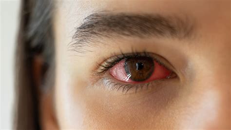 Viset eye drops for redness and irritation