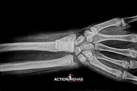 Image result for Distal Radius Fracture Recovery