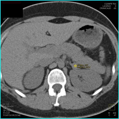 Adrenal Adenoma Ct Scan – Mr Imaging Adrenal Adenoma – DTWNIR