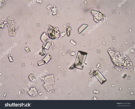 Amorphous Phosphate Crystals In Urine
