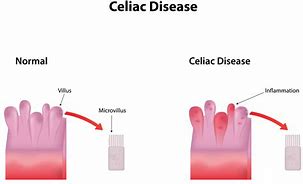 celiac 的图像结果