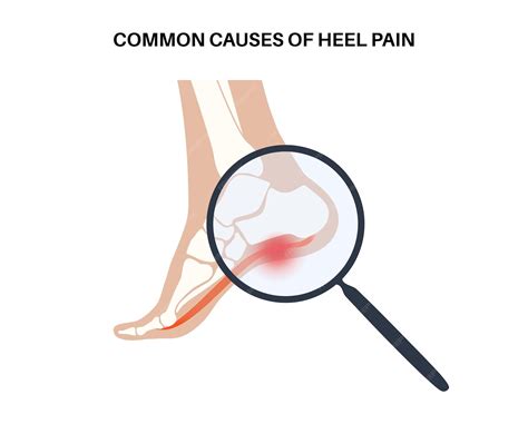 Premium Vector | Pain of the heel anatomical poster ankle and foot diseases calcaneal spur ...