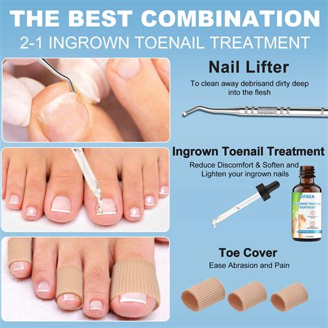 Effective Home Remedies for Ingrown Toenail Treatment: Quick Relief Guide