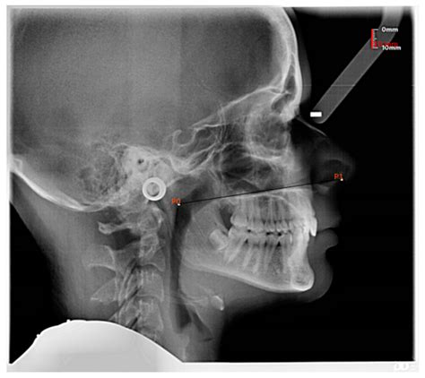 Adenoids Xray