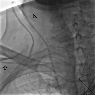 Image result for Perclose Device Tutorial