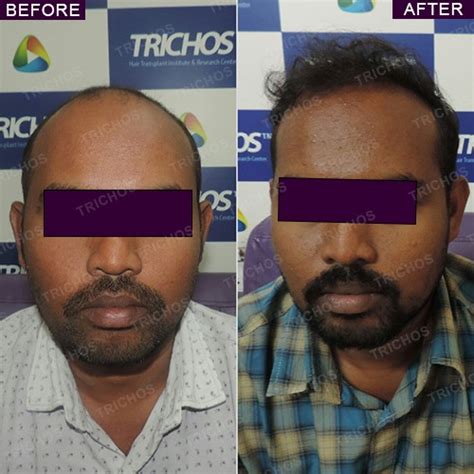 Trichos | Best Hair Treatment in Hyderabad | Dr John Watts