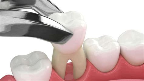 Tooth Socket After Extraction 的图像结果
