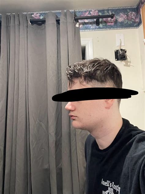 short face syndrome? I have invisalign for my overbite but i’m scared that my face doesn’t look ...