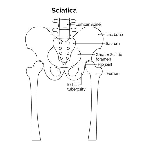 Premium Vector | Greater Sciatic foramen Hip Joint Femur Ischail tuberosity Sciatica Lumbar ...