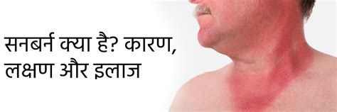 सनबर्न क्या है? कारण, लक्षण और इलाज | Sunburn in Hindi