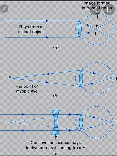draw diagrams to show correction of myopia - Brainly.in