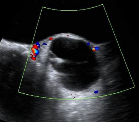 Ovarian Dermoid Cyst Collection Of Ultrasound Images