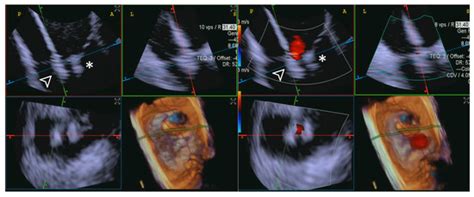 Early Experience with Acuson AcuNav 4D-ICE to Guide Transcatheter ...