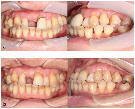 Biomechanical Considerations in the Orthodontic Treatment of a Patient ...