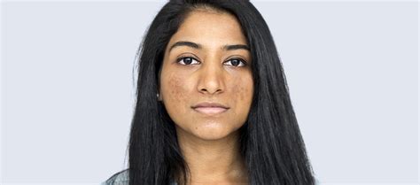 How to remove darkness around the mouth really fast? – Re'equil