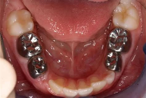3m Espe Stainless Steel Primary Crown E( 2nd Molar) – DentoClick.com