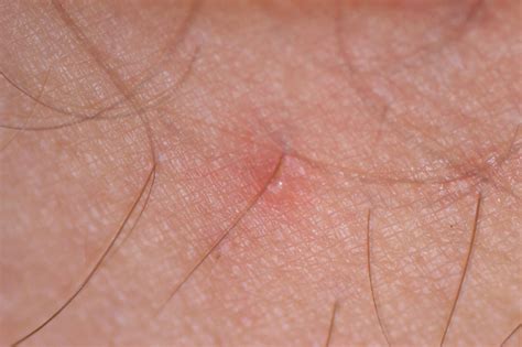 Chiggers: Everything You Need to Identify, Control & Get Rid of Them