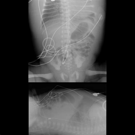 Umbilical Artery