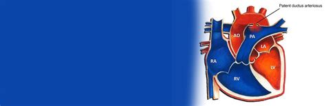 Intervention in a case with PDA (Patent Ductus Arteriosus) | Dr. S ...